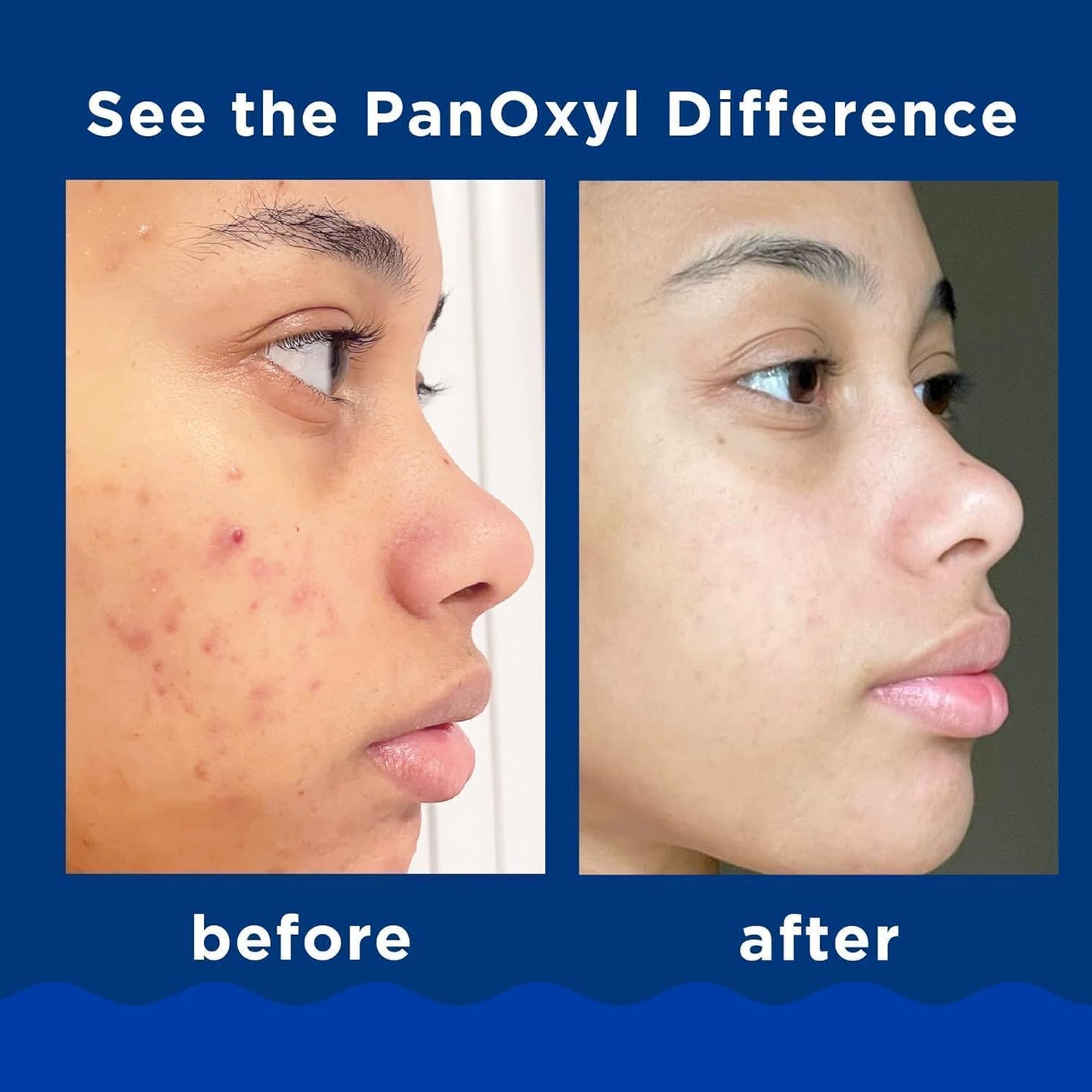 PanOxyl Acne Foaming Wash 10% Benzoyl Peroxide Maximum Strength